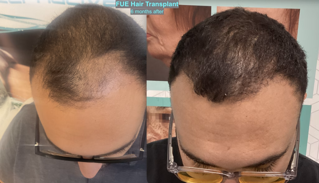 FUE Hair Transplant Treatment | Aesthetemed Beauty & Wellness Clinic