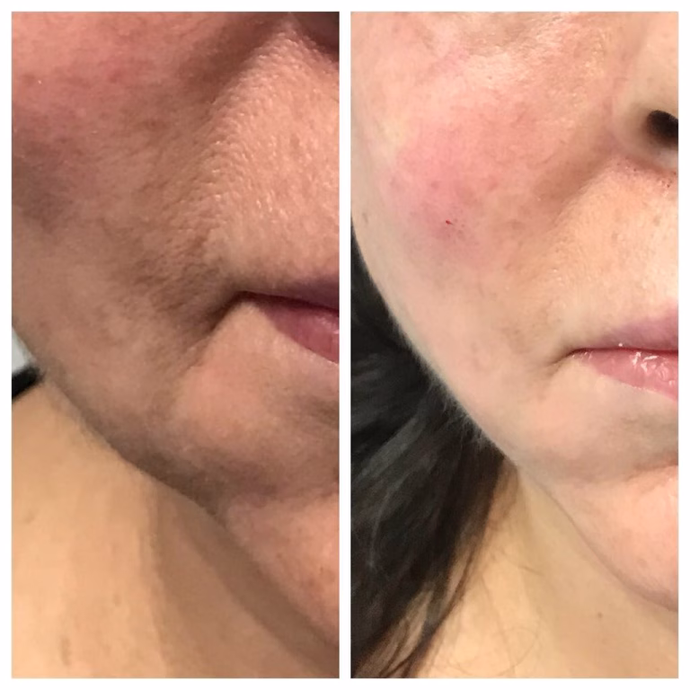 Endolift | Aesthetemed