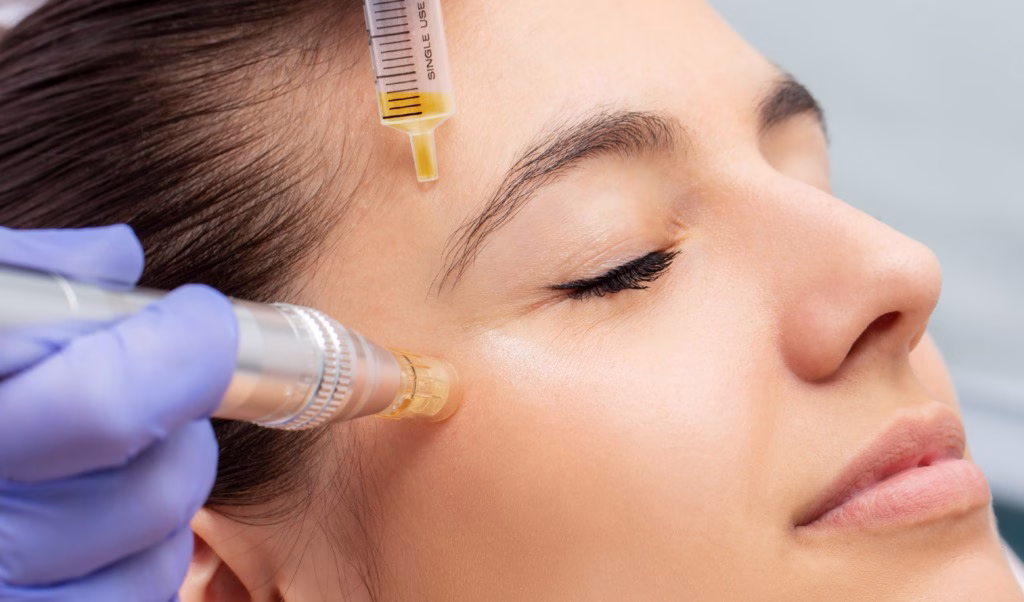 microneedling with PRP