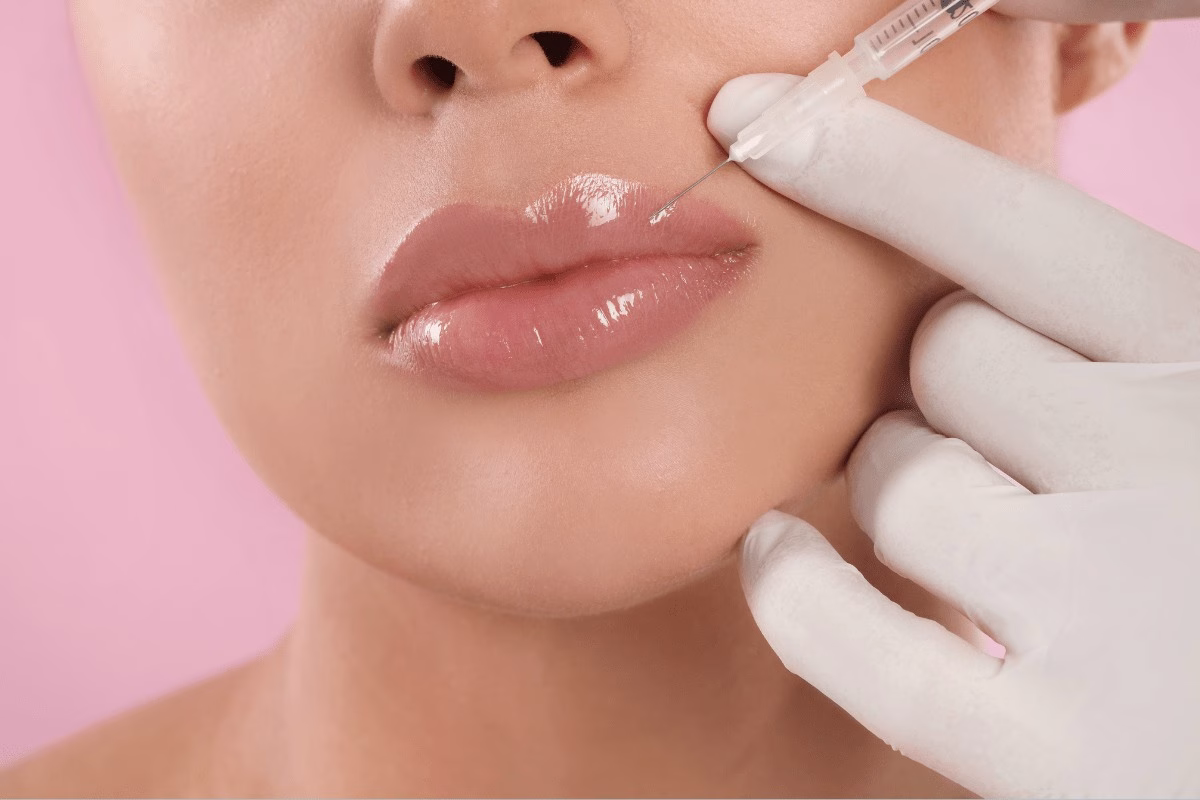 lip filler
