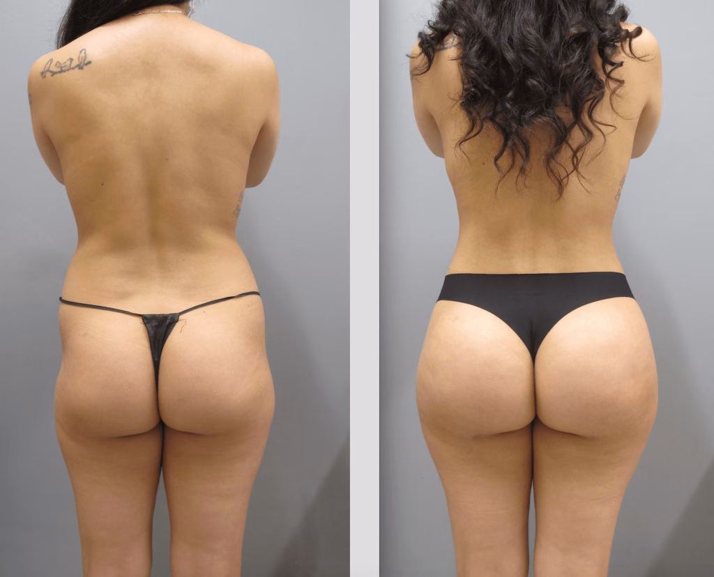 BBL | Brazilian Butt Lift