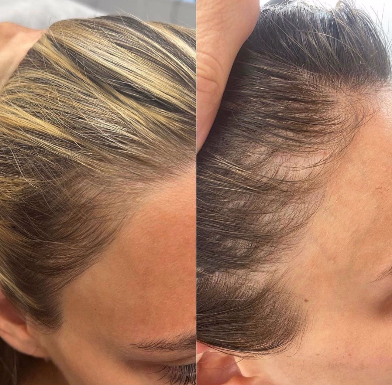 PRP Facial before and after for skin rejuvenation