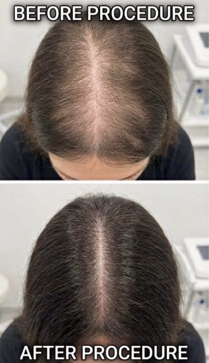 Exosome Hair Treatment - Hair Density Improvement