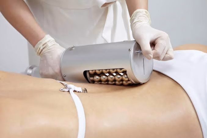 Endospheres Therapy results for body contouring