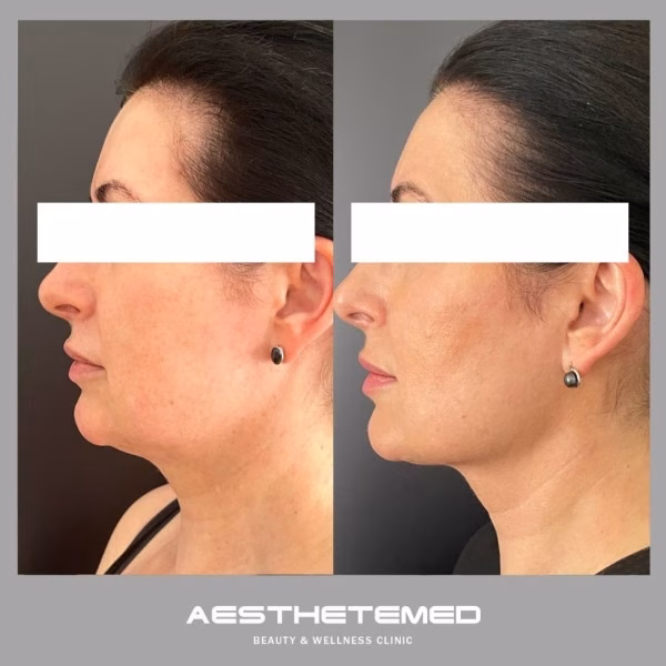 Endolift before and after 1