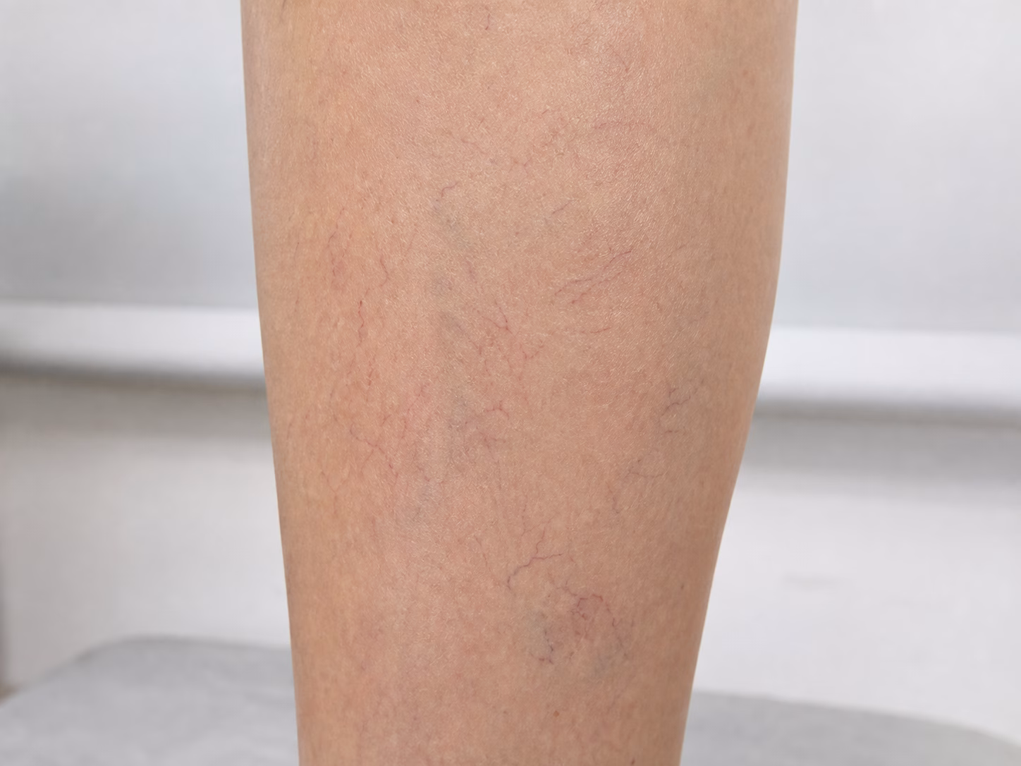 Fine, flat spider veins on a lower leg