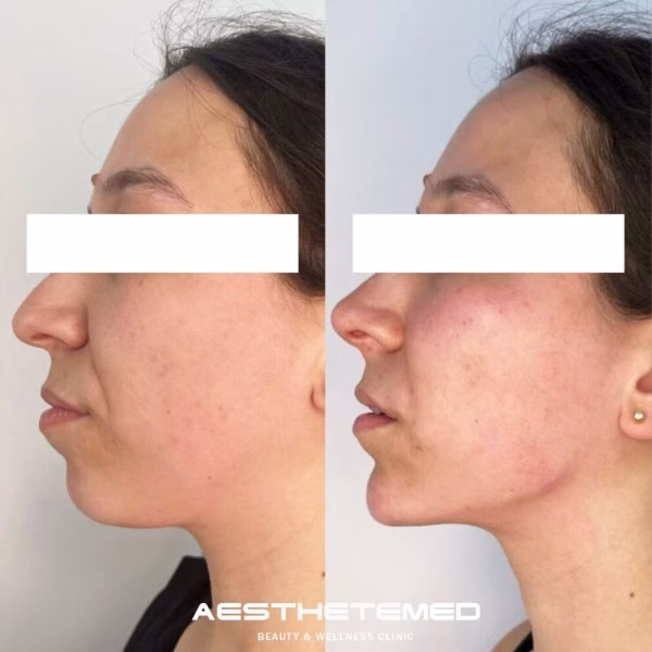 Endolift before and after 3