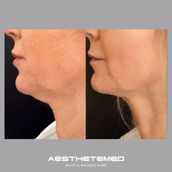 Endolift before and after 4