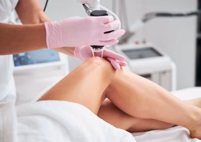 Laser spider vein removal treatment at Aesthetemed