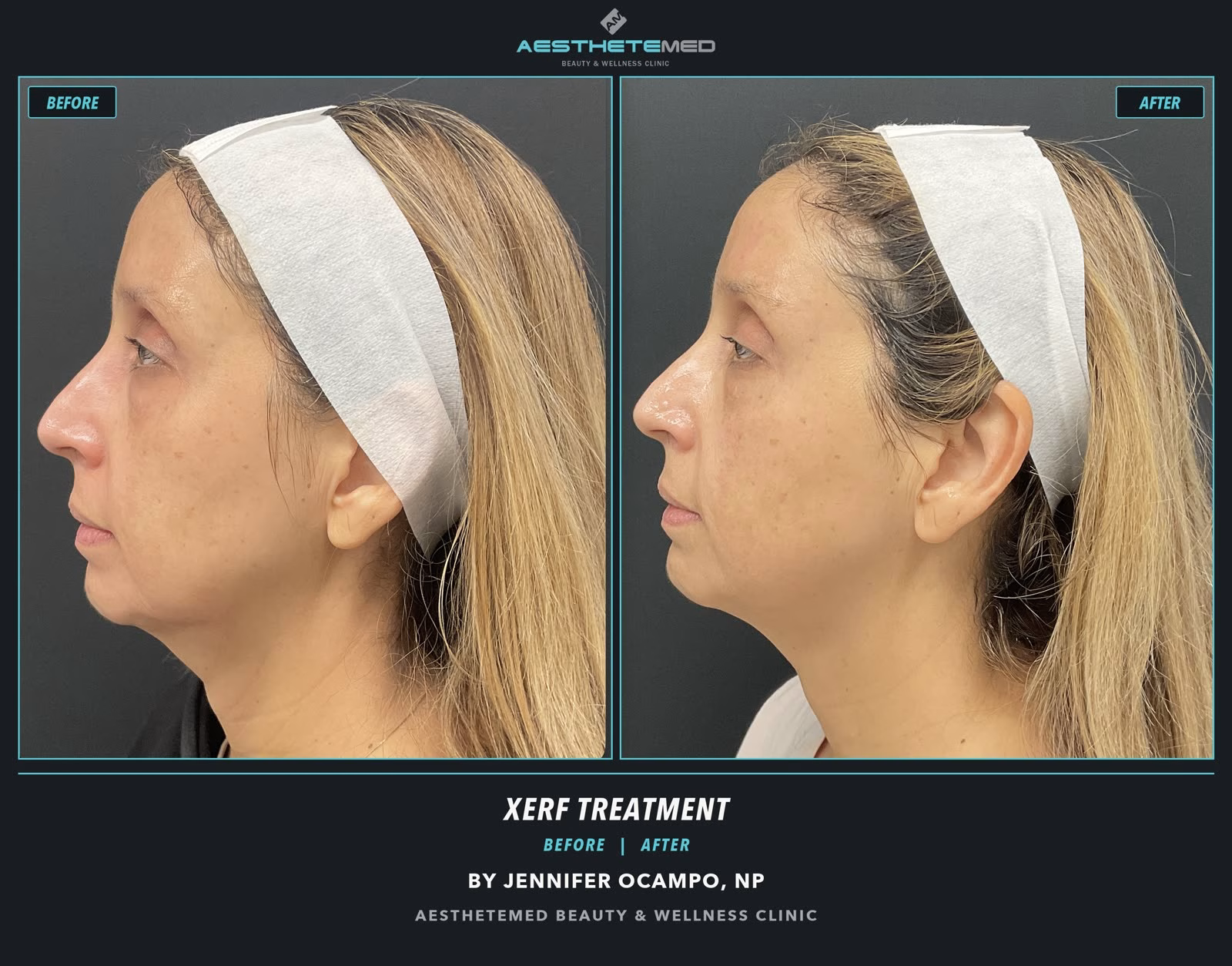 XERF lower face treatment before and after at AestheteMed. Individual results vary.